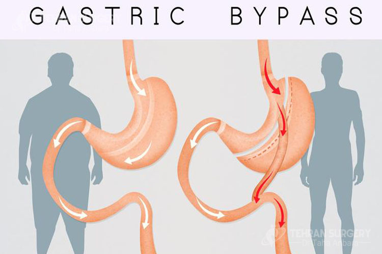 Gastric bypass 
