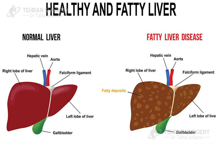 What is fatty liver?