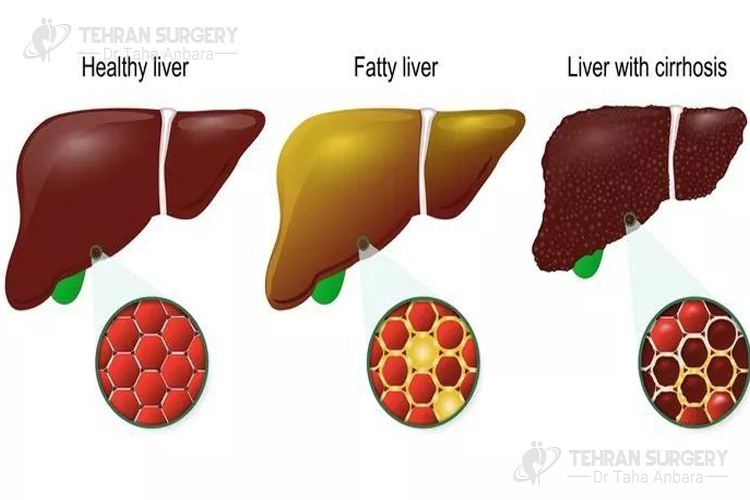 Symptoms of fatty liver disease