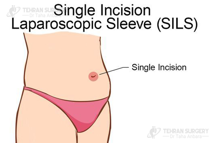 Single-incision gastric sleeve scars 