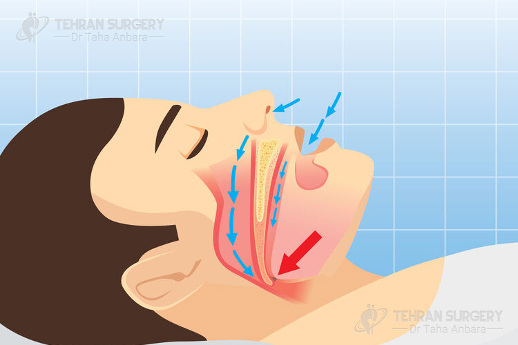 Sleep apnea symptoms