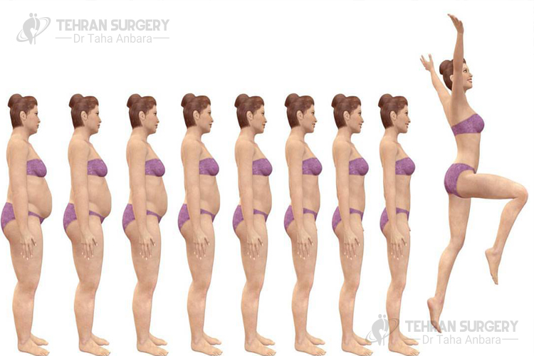 bariatric surgery requirements