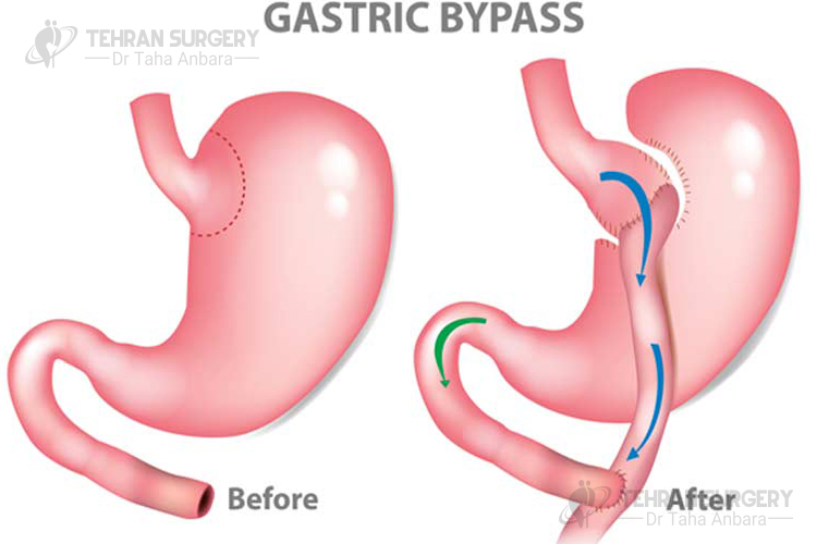 gastric bypass 