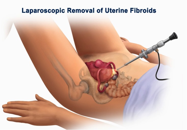 laparoscopic surgery