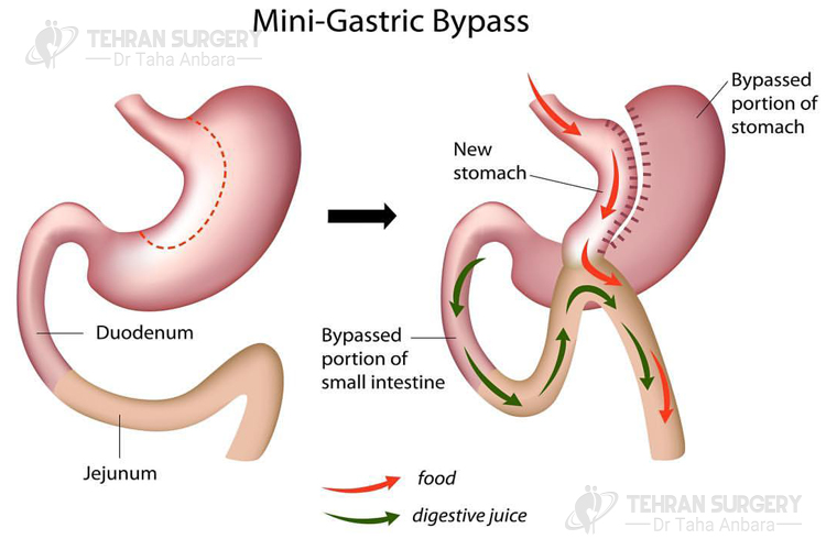 Mini gastric bypass procedure