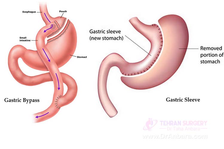 Gastric sleeve surgery and gastric bypass surgery