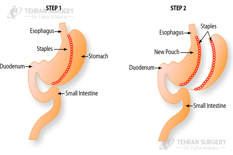 Gastric sleeve surgery