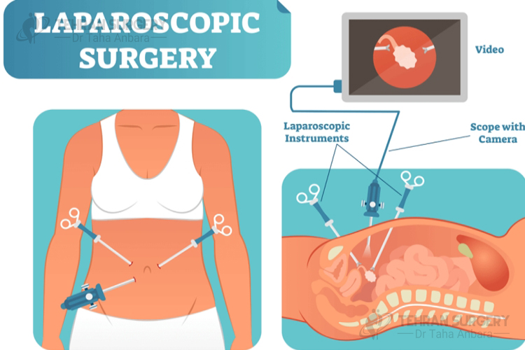 Laparoscopic gastric sleeve scars (typically 3-5 incisions)