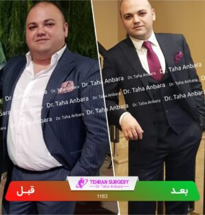 عکس قبل و بعد جراحی لاغری