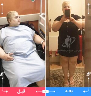 عکس قبل و بعد جراحی لاغری