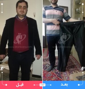 عکس قبل و بعد جراحی لاغری